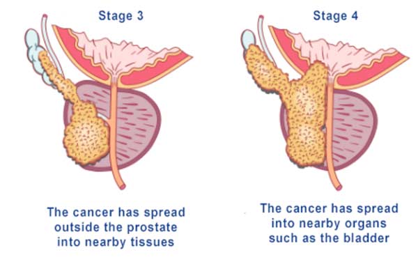 Stages of prostate cancer